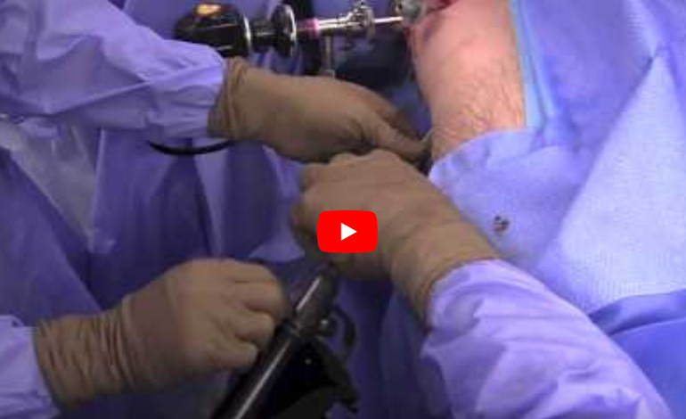 Arthroscopic Assisted Core Decompression of the Hip
