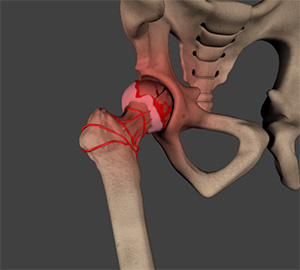 avascular-necrosis-hip